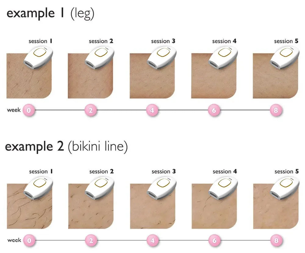 Laser Hair Removal & Skin Rejuvenation Device – Painless Full-Body Care